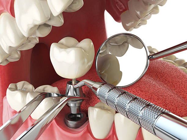 Best Broken or Chipped Tooth Repair in Wollochet, WA